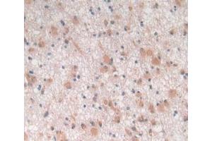 IHC-P analysis of Human Glioma Tissue, with DAB staining. (TGFB3 antibody  (AA 24-300))