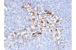 Formalin-fixed, paraffin-embedded human Melanoma stained with CD146 Monoclonal Antibody (C146/634) (MCAM antibody)