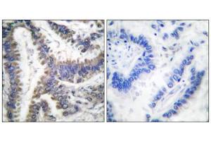Immunohistochemical analysis of paraffin-embedded human lung carcinoma tissue, using DFF45 (Cleaved-Asp224) antibody. (DFFA antibody  (Cleaved-Asp224, Internal Region))