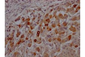 IHC image of  diluted at 1:100 and staining in paraffin-embedded human breast cancer performed on a Leica BondTM system. (Recombinant GSK3 beta antibody)