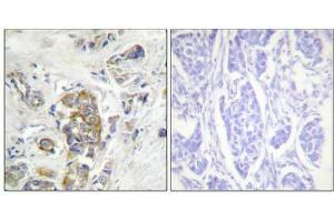 Immunohistochemical analysis of paraffin-embedded human breast carcinoma tissue, using ITGB4 (Phospho-Tyr1510) antibody (left)or the same antibody preincubated with blocking peptide (right). (Integrin beta 4 antibody  (pTyr1510))