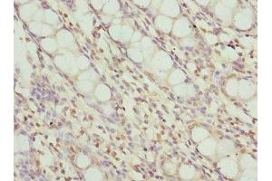 Immunohistochemistry of paraffin-embedded human colon tissue using ABIN7174024 at dilution of 1:100 (FRK antibody  (AA 1-220))