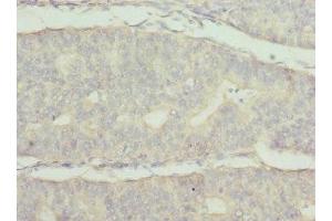 Immunohistochemistry of paraffin-embedded human endometrial cancer using ABIN7174024 at dilution of 1:100 (FRK antibody  (AA 1-220))