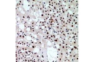 Immunohistochemical analysis of CHD4 staining in human liver cancer formalin fixed paraffin embedded tissue section. (CHD4 antibody)