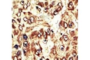 IHC analysis of FFPE human hepatocarcinoma tissue stained with the WEE1 antibody (WEE1 antibody  (AA 604-634))