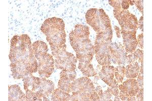 Immunohistochemistry (IHC) image for anti-Epithelial Cell Adhesion Molecule (EPCAM) (AA 77-202), (Extracellular Domain) antibody (ABIN6939985)