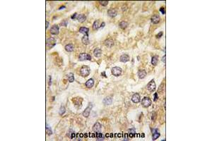 Formalin-fixed and paraffin-embedded human prostata carcinoma tissue reacted with MAP2K2 Antibody (T394) , which was peroxidase-conjugated to the secondary antibody, followed by DAB staining. (MEK2 antibody  (AA 372-400))