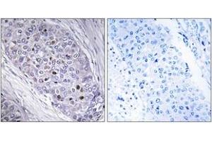 Immunohistochemistry analysis of paraffin-embedded human breast carcinoma tissue, using MEF2C Antibody. (MEF2C antibody  (AA 411-460))