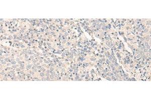 Immunohistochemistry of paraffin-embedded Human cervical cancer tissue using RADIL Polyclonal Antibody at dilution of 1:40(x200) (Radil antibody)