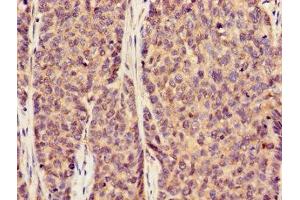 Immunohistochemistry of paraffin-embedded human ovarian cancer using ABIN7170002 at dilution of 1:100 (GLUT1 antibody  (AA 263-458))