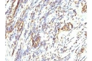 Formalin-fixed, paraffin-embedded human Leiomyosarcoma stained with anti-Vimentin antibody. (Vimentin antibody)