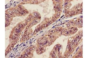 Immunohistochemistry of paraffin-embedded human endometrial cancer using ABIN7142023 at dilution of 1:100 (AGPAT5 antibody  (AA 174-313))