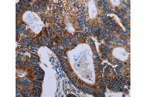 Immunohistochemistry of Human colon cancer using F11R Polyclonal Antibody at dilution of 1:40 (F11R antibody)