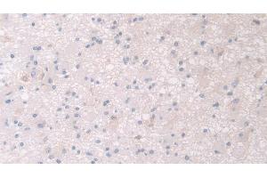 Detection of PANK4 in Human Glioma Tissue using Polyclonal Antibody to Pantothenate Kinase 4 (PANK4) (PANK4 antibody  (AA 639-773))