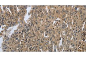 Immunohistochemistry of paraffin-embedded Human ovarian cancer tissue using PTPRT Polyclonal Antibody at dilution 1:30 (PTPRT antibody)