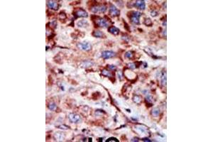 Formalin-fixed and paraffin-embedded human cancer tissue reacted with the primary antibody, which was peroxidase-conjugated to the secondary antibody, followed by AEC staining. (Adenylate Kinase 2 antibody  (C-Term))