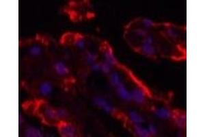 Immunofluorescence analysis of Human lung cancer tissue using Galectin 3 Monoclonal Antibody at dilution of 1:200. (Galectin 3 antibody)