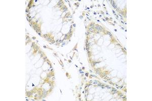 Immunohistochemistry of paraffin-embedded human stomach cancer using CUL3 antibody at dilution of 1:100 (40x lens). (Cullin 3 antibody)