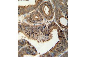 SFN antibody (C-term)  immunohistochemistry analysis in formalin fixed and paraffin embedded human prostate carcinoma followed by peroxidase conjugation of the secondary antibody and DAB staining. (14-3-3 sigma/SFN antibody  (C-Term))