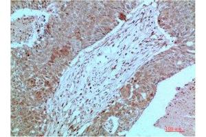 Immunohistochemical analysis of paraffin-embedded Human Breast Carcinoma Tissue using JAK2 Mouse mAb diluted at 1:2000 (JAK2 antibody)