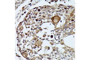 Immunohistochemistry of paraffin-embedded human esophageal cancer using MEKK3 antibody (ABIN7268652) at dilution of 1:100 (40x lens). (MAP3K3 antibody  (AA 1-220))