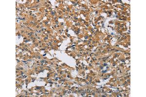 Immunohistochemistry of Human gastric cancer using DNMT3A Polyclonal Antibody at dilution of 1:50 (DNMT3A antibody)