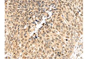 The image on the left is immunohistochemistry of paraffin-embedded Human lung cancer tissue using ABIN7192036(PSMB8 Antibody) at dilution 1/30, on the right is treated with synthetic peptide. (PSMB8 antibody)