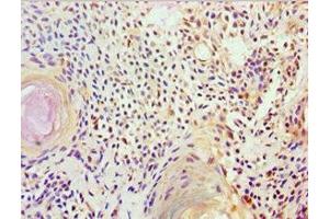 Immunohistochemistry of paraffin-embedded human breast cancer using ABIN7152570 at dilution of 1:100 (FUBP3 antibody  (AA 65-260))