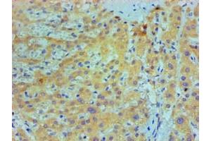 Immunohistochemical of paraffin-embedded Human live cancer tissue using ABIN7156047 at dilution of 1:200. (IL1A antibody)