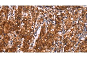 Immunohistochemistry of paraffin-embedded Human gastric cancer using BRK1 Polyclonal Antibody at dilution of 1:40 (BRK1 antibody)
