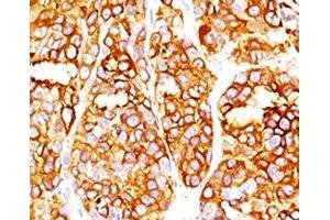 Formalin-fixed, paraffin-embedded human melanoma stained with MART-1 antibody (SPM540). (Recombinant MLANA antibody)