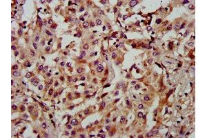 IHC image of ABIN7160745 diluted at 1:900 and staining in paraffin-embedded human liver cancer performed on a Leica BondTM system. (FAM174A antibody  (AA 1-94))