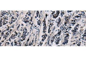 Immunohistochemistry of paraffin-embedded Human breast cancer tissue using SNIP1 Polyclonal Antibody at dilution of 1:80(x200) (SNIP1 antibody)