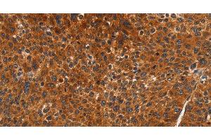 Immunohistochemistry of paraffin-embedded Human liver cancer using CDK19 Polyclonal Antibody at dilution of 1:70 (CDK19 antibody)