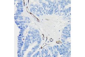 Immunohistochemistry of paraffin-embedded human oophoroma using CD31/PEC Rabbit mAb (ABIN7269406) at dilution of 1:25 (40x lens). (CD31 antibody)