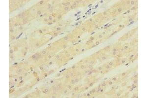 Immunohistochemistry of paraffin-embedded human gastric cancer using ABIN7143005 at dilution of 1:100 (ACCN5 antibody  (AA 140-330))