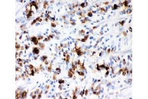 IHC-P: MUC5AC antibody testing of human gastric cancer tissue (MUC5AC antibody  (AA 4848-5030))