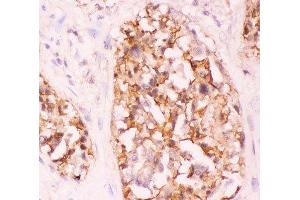 IHC-P: Crk antibody testing of human lung cancer tissue (Crk antibody  (AA 2-246))