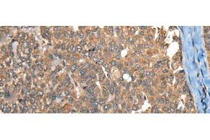 Immunohistochemistry of paraffin-embedded Human liver cancer tissue using C1R Polyclonal Antibody at dilution of 1:40(x200) (C1R antibody)