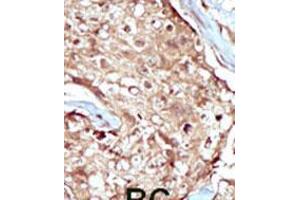 Formalin-fixed and paraffin-embedded human cancer tissue reacted with the primary antibody, which was peroxidase-conjugated to the secondary antibody, followed by AEC staining. (PAPSS2 antibody  (C-Term))