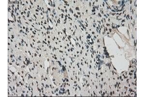 Immunohistochemical staining of paraffin-embedded colon tissue using anti-FERMT2mouse monoclonal antibody. (FERMT2 antibody)