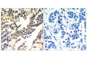 Immunohistochemical analysis of paraffin-embedded human breast carcinoma tissue using c-Cbl (Ab-700) Antibody (E021549). (CBL antibody)