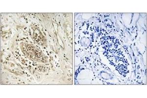 Immunohistochemistry analysis of paraffin-embedded human breast carcinoma tissue, using POLE1 Antibody. (POLE antibody  (AA 1261-1310))