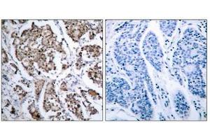 Immunohistochemical analysis of paraffin-embedded human breast carcinoma tissue using BAD (phospho- Ser155) antibody. (BAD antibody  (pSer155))