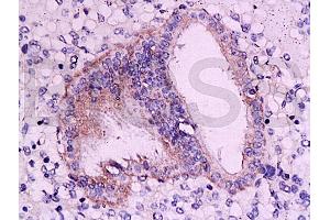 Formalin-fixed and paraffin embedded: human endometrium tissue labeled with Anti-RAR-alpha Polyclonal Antibody, Unconjugated (ABIN726860) at 1:200, followed by conjugation to the secondary antibody and DAB staining (Retinoic Acid Receptor alpha antibody  (AA 361-462))