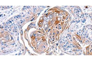 Immunohistochemistry of paraffin-embedded Human esophagus cancer tissue using CX3CL1 Polyclonal Antibody at dilution 1:30 (CX3CL1 antibody)