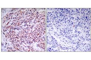 Immunohistochemical analysis of paraffin- embedded human breast carcinoma tissue using NF-κB p65 (Ab-435) antibody (E021012). (NF-kB p65 antibody)