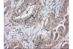 Immunohistochemical staining of paraffin-embedded Adenocarcinoma of Human colon tissue using anti-TBXAS1 mouse monoclonal antibody. (TBXAS1 antibody)