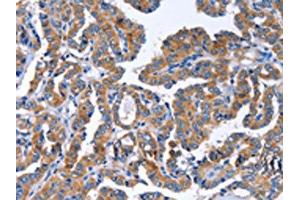 The image on the left is immunohistochemistry of paraffin-embedded Human thyroid cancer tissue using ABIN7129821(IGSF10 Antibody) at dilution 1/50, on the right is treated with fusion protein. (IGSF1 antibody)