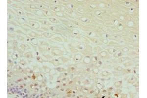 Immunohistochemistry of paraffin-embedded human cervical cancer using ABIN7149983 at dilution of 1:100 (DPP3 antibody  (AA 1-280))